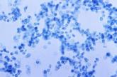 Coccidioidomycosis a respiratory threat to construction workers in Southwest